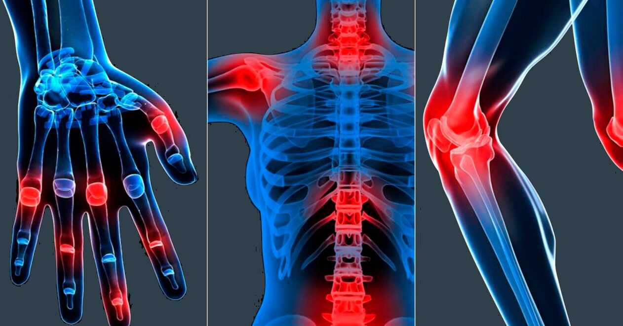 Wskazania do stosowania ekstraktu z Boswellii w kapsułkach