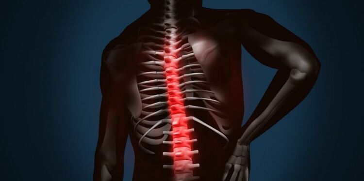 zmiany kręgosłupa spowodowane osteochondrozą
